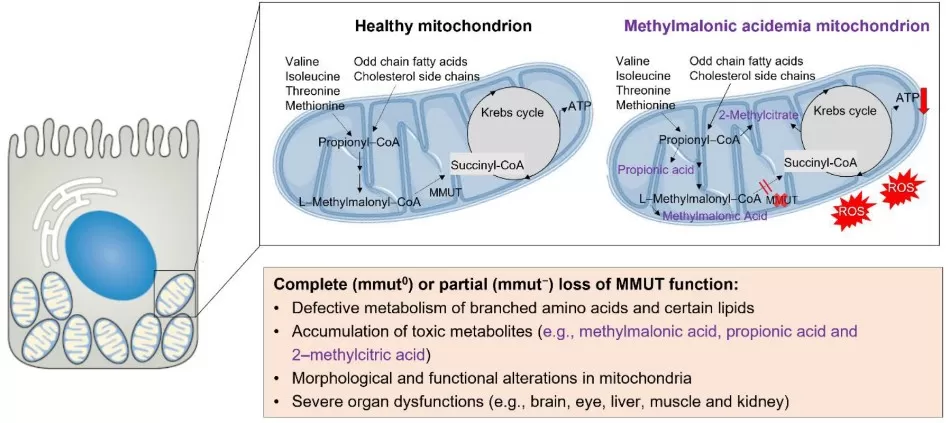 Schematic showing PCC (PCCA/PCCB), MCEE, and B12-dependent MMUT converting propionyl-CoA to succinyl-CoA; highlights MMA accumulation in methylmalonic acidemia.